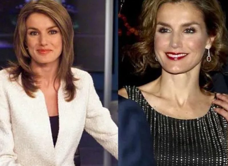 EL AUMENTO DE PÓMULOS DE LA REINA LETIZIA