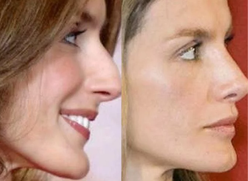 LA MENTOPLASTIA DE LA REINA LETIZIA