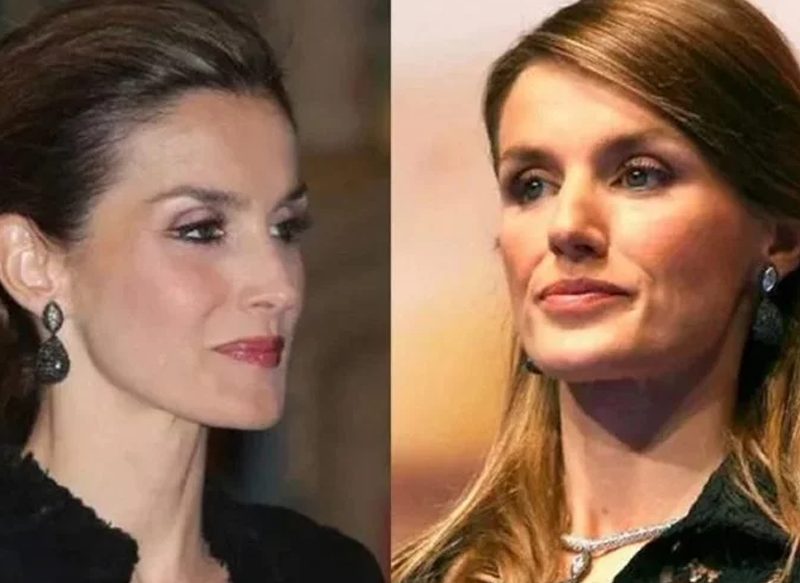 LA ELIMINACIÓN DE LAS BOLAS DE BICHAT DE LA REINA LETIZIA