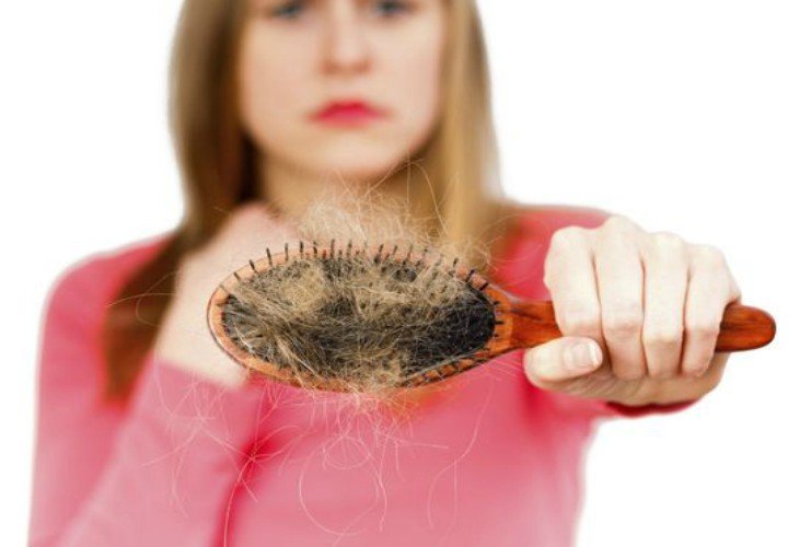 alopecia
