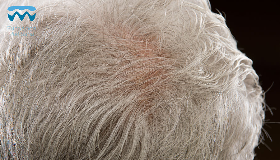 ¿Cómo quitar las canas?