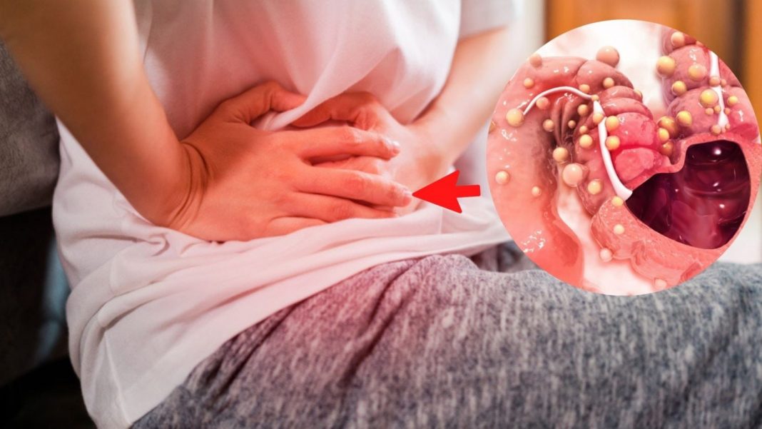 ¿Cómo crece el cáncer de colon?