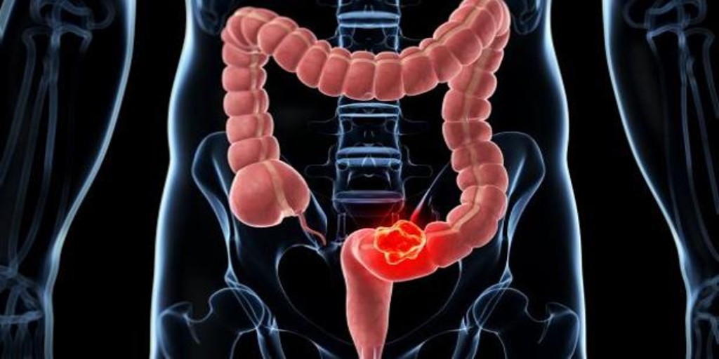 cáncer colon