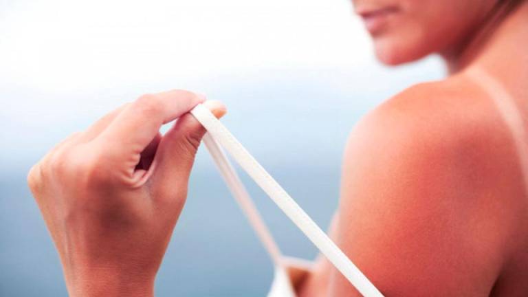 El aloe vera es el mejor aliado para combatir las quemaduras