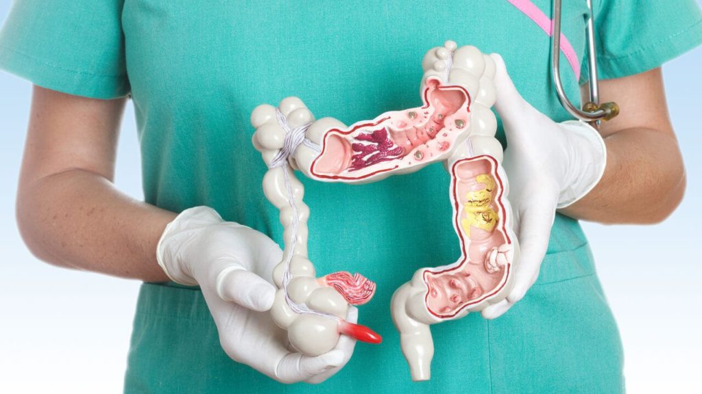 Cáncer colorrectal: como la detección temprana puede salvar vidas 1 Moncloa La importancia de la detección temprana del cáncer colorrectal