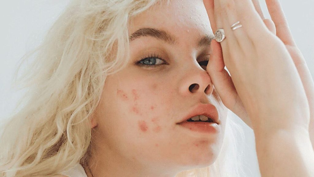 Acné: se hace viral increíble truco para quitarlo definitivamente de tu rostro 2 Moncloa acne 1 Moncloa