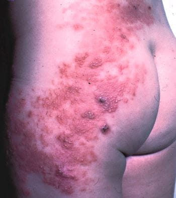 ¿Has cogido el herpes Zóster? Pues acaba con él con los mejores tratamientos según los expertos 1 Moncloa 473 herpes zoster lumbar dermatome slide 8 springer high es Moncloa