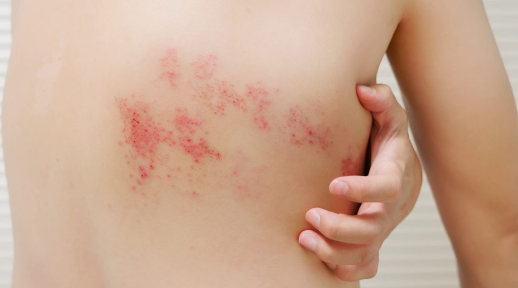 ¿Has cogido el herpes Zóster? Pues acaba con él con los mejores tratamientos según los expertos 2 Moncloa 9f610fb566aec19933f6aae68d6d0cc466648fb6 Moncloa