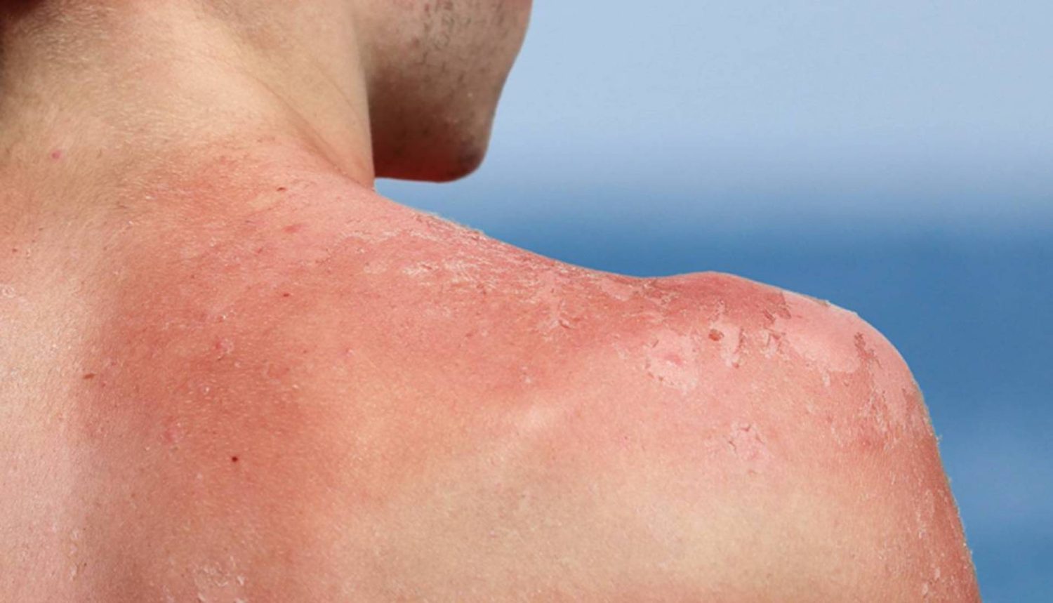 Cáncer de piel en ascenso: la peligrosa negligencia del sol 2 Moncloa La peligrosa negligencia del sol