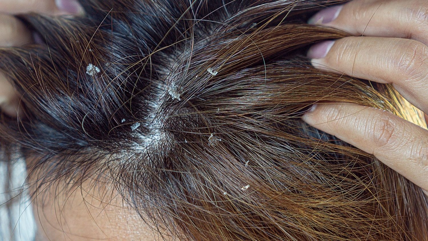 Despídete de la caspa con 10 poderosos remedios naturales: una solución efectiva para un cuero cabelludo saludable 2 Moncloa PASOS A SEGUIR PARA UN TRATAMIENTO EFECTIVO