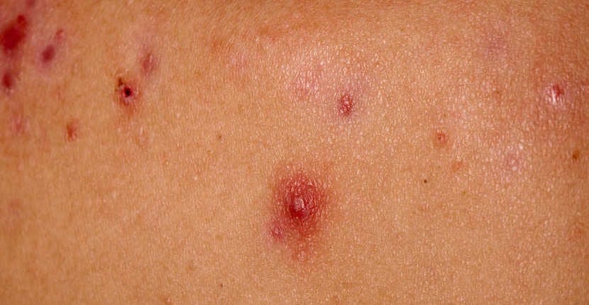 Descubre trucos caseros infalibles para erradicar granos en espalda y glúteos. ¡Libérate de imperfecciones con estos consejos efectivos! 1 Moncloa PREVENCIÓN Y LIMPIEZA DIARIA