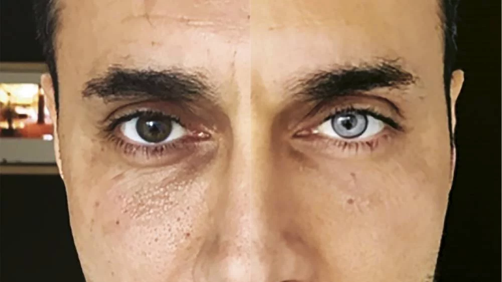 La cirugía más riesgosa del mundo que cambia tu color de ojos y es tendencia 1 Moncloa Los aspectos negativos de la cirugía