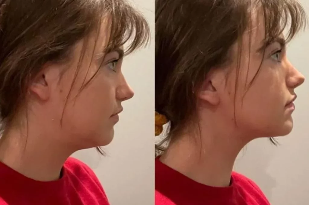 Qué es el mewing: la técnica viral que promete eliminar la papada y especialistas no recomiendan 1 Moncloa Otras técnicas para sustituir el mewing