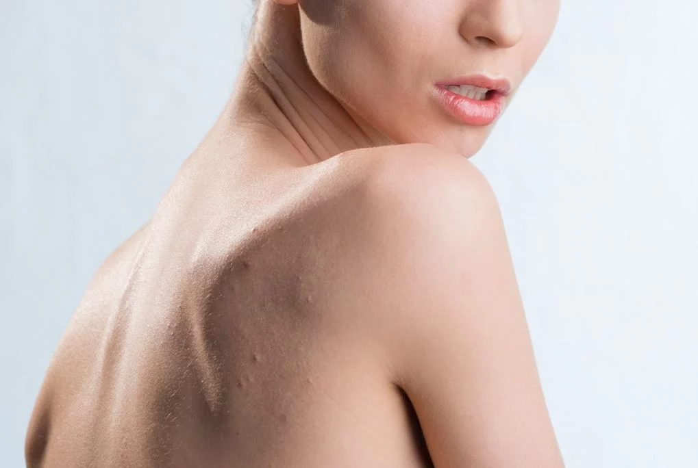 Dile adiós a los granos en la espalda: La guía definitiva para una piel libre de imperfecciones 2 Moncloa Cómo eliminamos los granos de la espalda