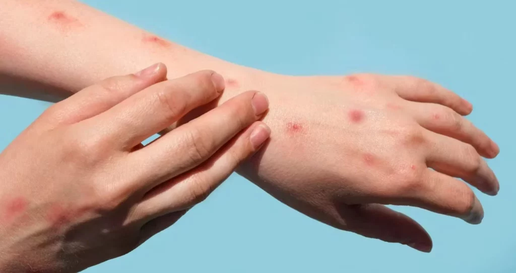 Estas son las tres formas de transmisión de la viruela del mono que advierten los expertos 1 Moncloa ¿Cómo evitar la viruela del mono?