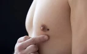 cancer mama masculino