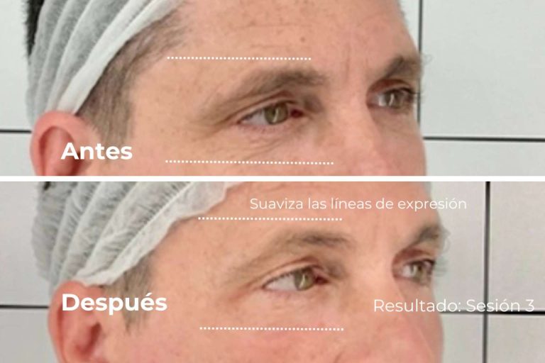 Lifting 4D, el nuevo estándar mundial para un rejuvenecimiento sin inyecciones y duradero