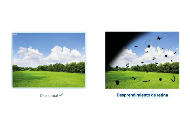 Deporte y desprendimiento de retina: ¿es seguro practicar ejercicio tras la cirugía?