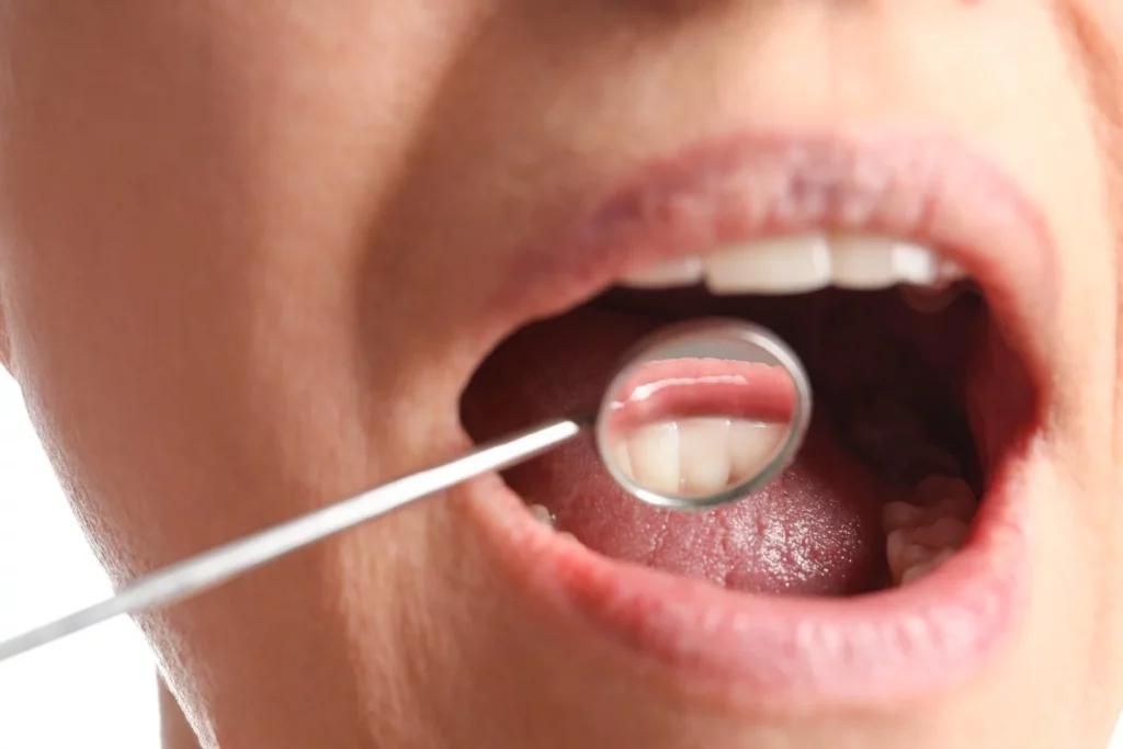 MÁS ALLÁ DE LAS CARIES: OTROS PELIGROS DE LA INVASIÓN BACTERIANA