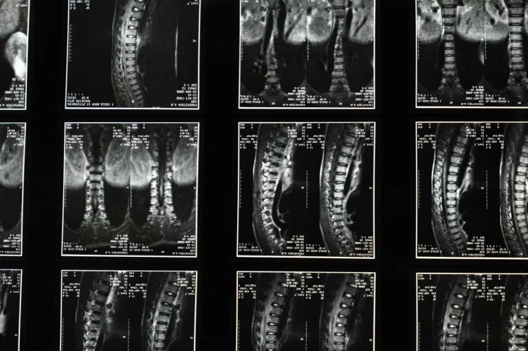 El truco de los fisios para aliviar el dolor lumbar sin medicación