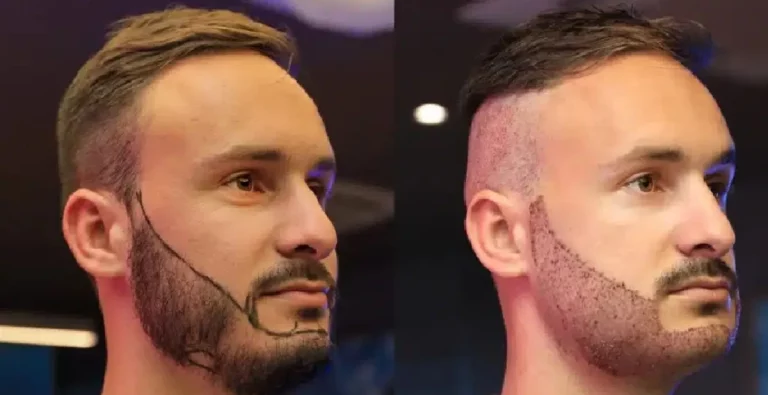Por qué cada vez más hombres optan por el injerto de barba para reforzar su imagen