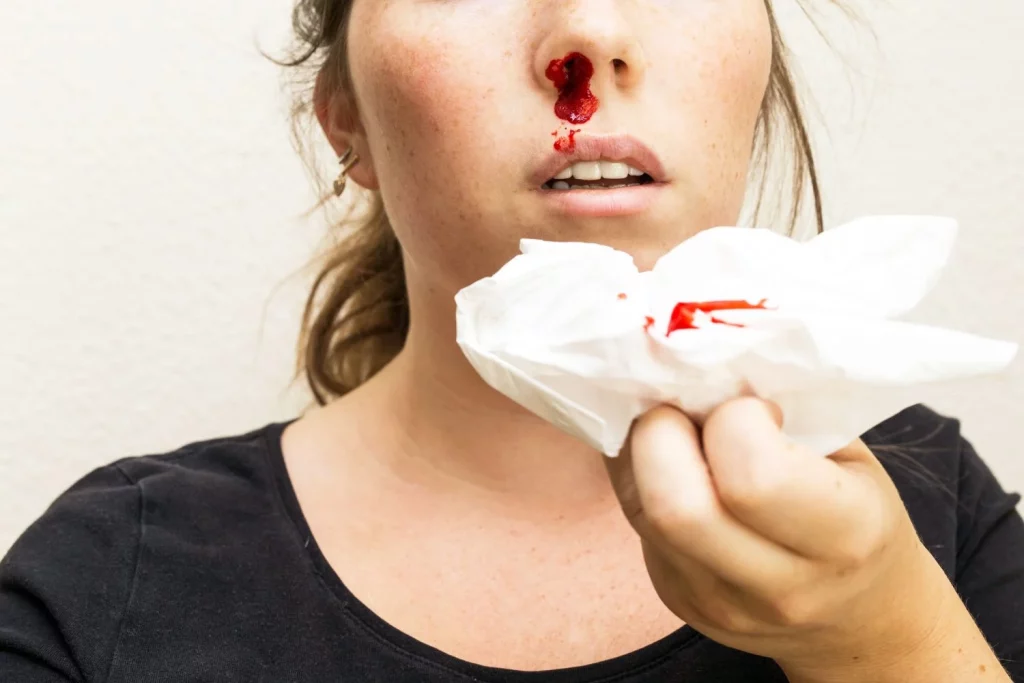herida hemorragia nasal mujer sangrando por la nariz herida en la nariz sangre y tejido Moncloa