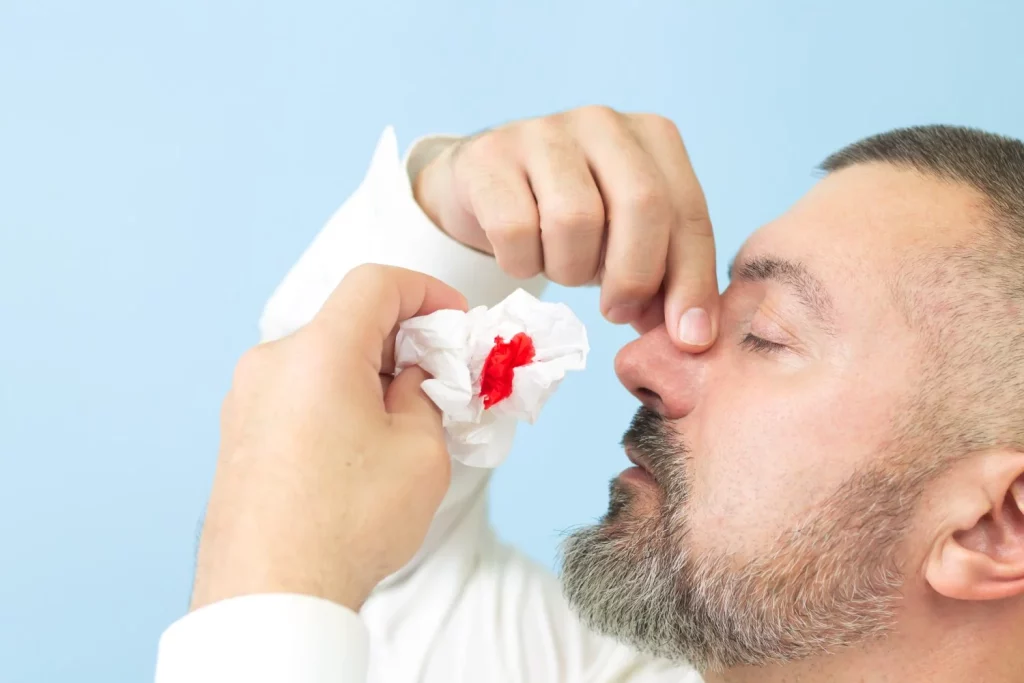 hombre que sufre de hemorragia nasal o epistaxis y usa un panuelo de papel para detener el sangrado Moncloa