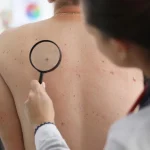 Dra. Eva Soler (51), dermatóloga: «Ese grano que no se va no es acné. Es un tipo de cáncer de piel que el 80% confunde»