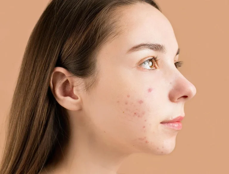 Raquel Velasco Diez (49 años), medicina estética te enseña a diferenciar si sufres acné o rosacea