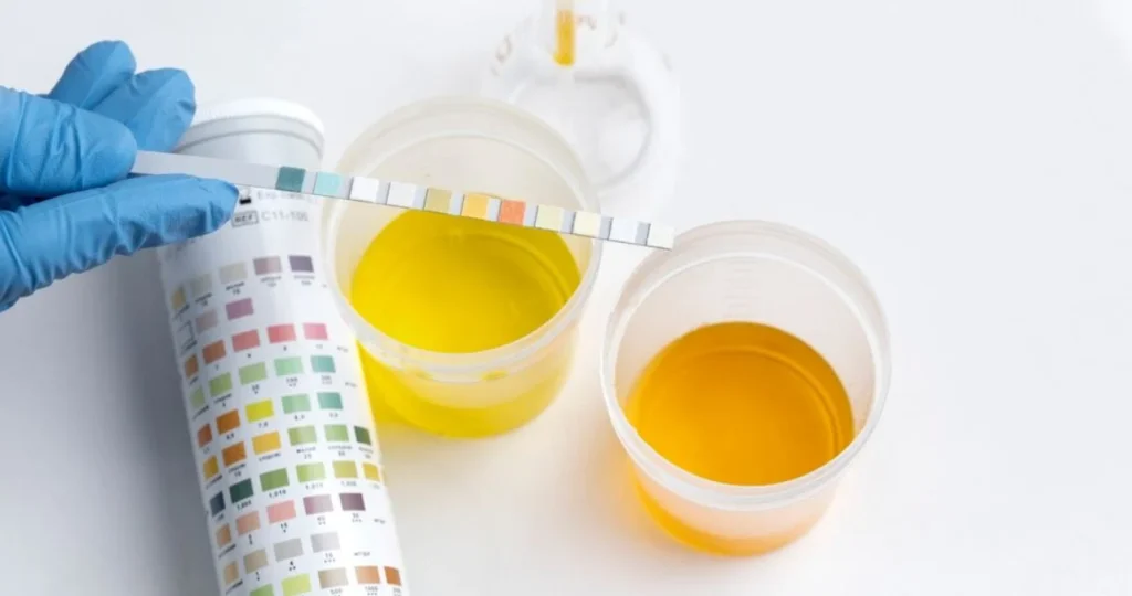 La clave para detectar está en el color de la orina