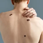 Dr. Cristina Vega (39), dermatóloga: «Ese lunar que cambia de color es lo que se convierte en melanoma en 1 de cada 20 casos. Revísalo hoy o en meses es metástasis»