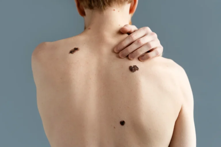 Dr. Cristina Vega (39), dermatóloga: «Ese lunar que cambia de color es lo que se convierte en melanoma en 1 de cada 20 casos. Revísalo hoy o en meses es metástasis»