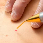 “Si te aparecen lunares rojos en la piel, NO los arranques”: el Dr. Martín Salazar (48), dermatólogo, explica por qué sangran tanto y cuándo preocuparse