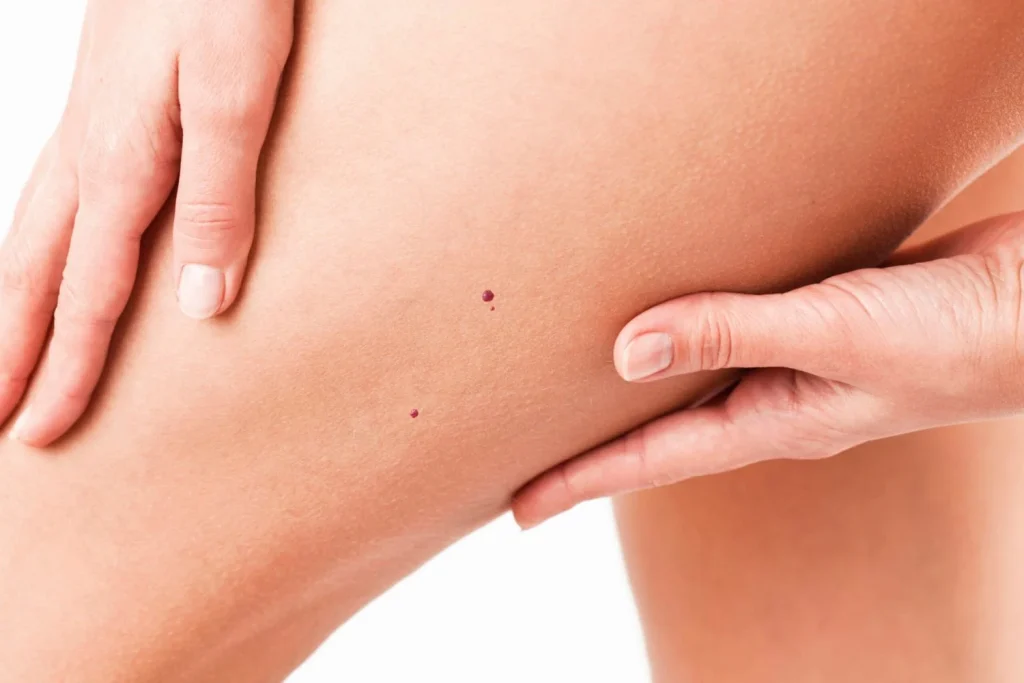 “Si te aparecen lunares rojos en la piel, NO los arranques”: el Dr. Martín Salazar (48), dermatólogo, explica por qué sangran tanto y cuándo preocuparse 1 Moncloa ¿Lunares rojos en la piel? aprende a identificarlos