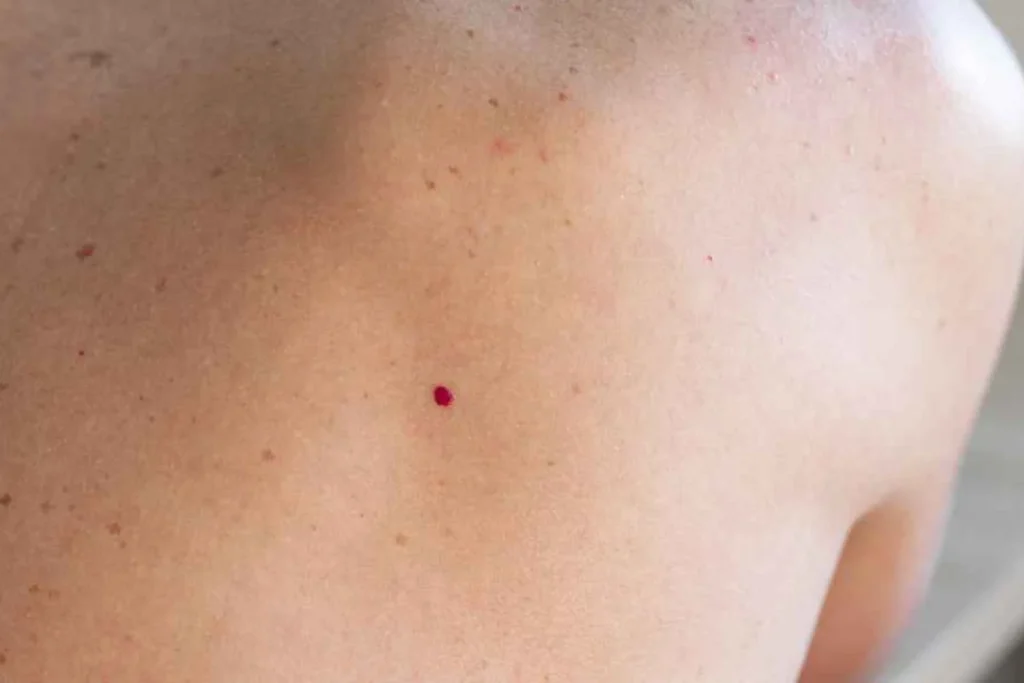 “Si te aparecen lunares rojos en la piel, NO los arranques”: el Dr. Martín Salazar (48), dermatólogo, explica por qué sangran tanto y cuándo preocuparse 2 Moncloa ¿Son peligrosos los lunares rojos en la piel?