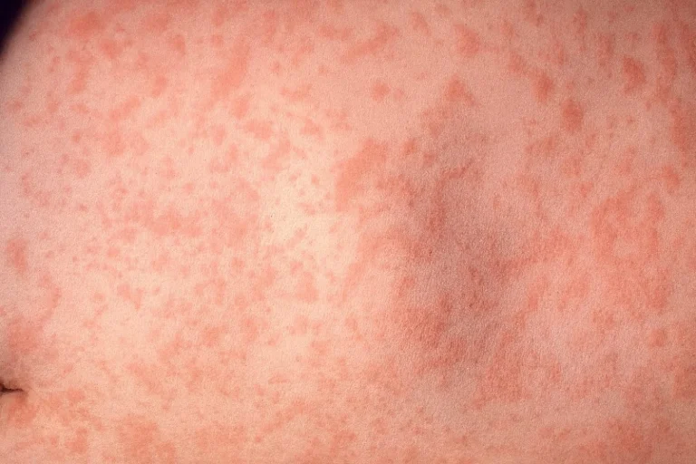 Lo que debes saber si naciste entre 1970 y 1980 sobre el nuevo brote de sarampión